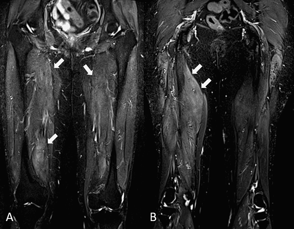 MRI-of-the-thighs