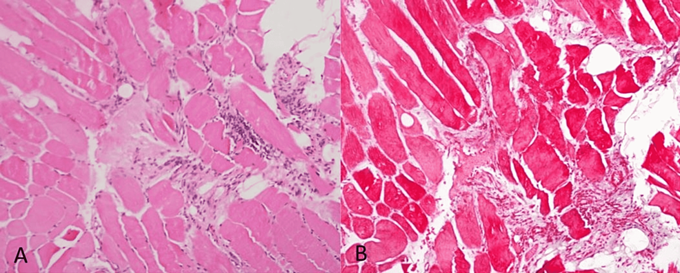 Muscle-biopsies