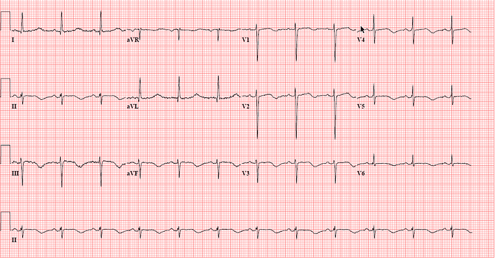 Cureus | Vandetanib-Induced Hyponatremia and Torsades De Pointes: A ...