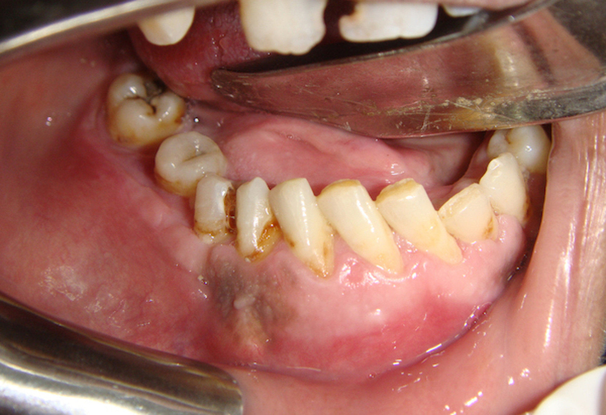 central cementifying fibroma