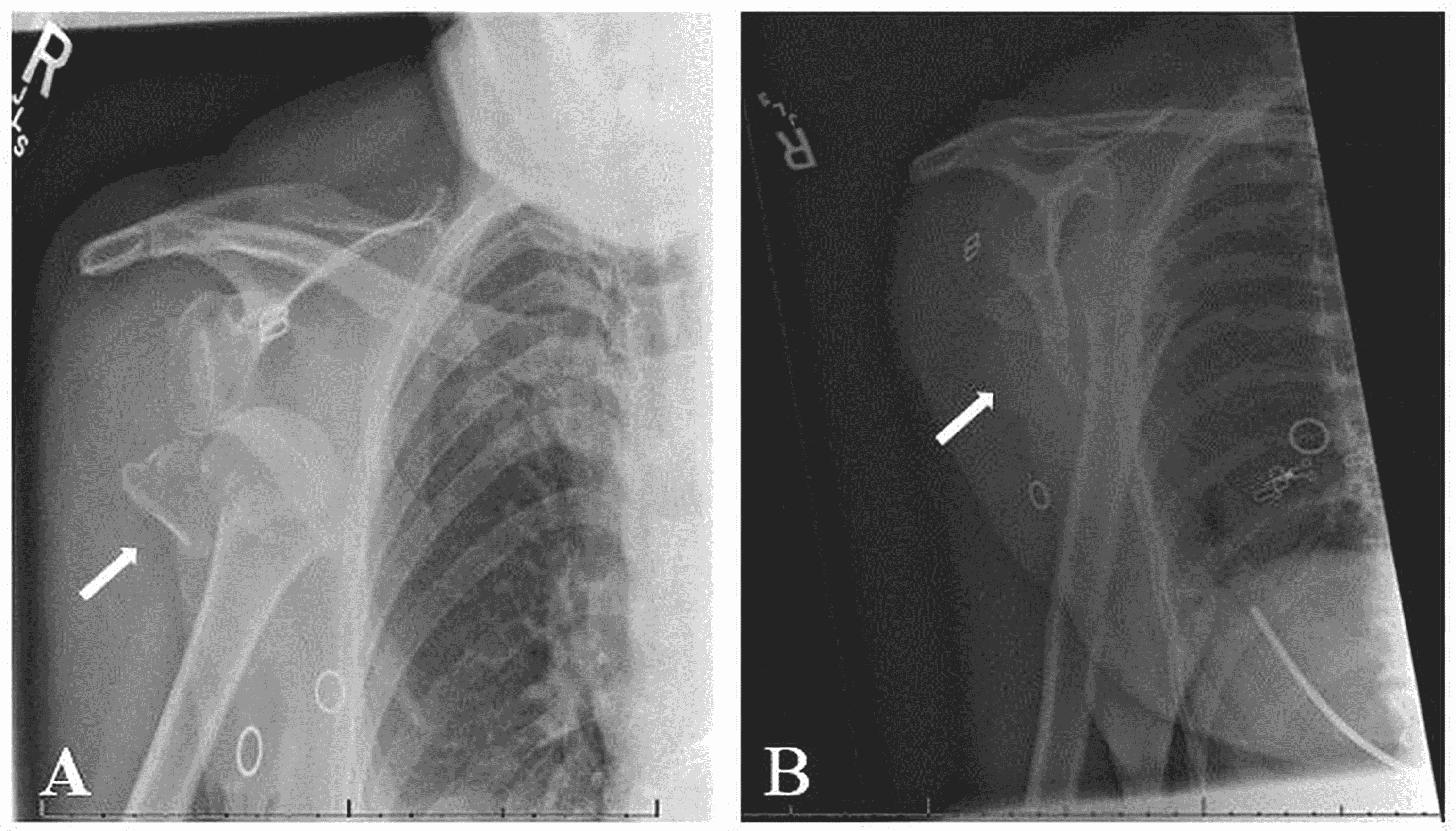 Cureus A Case Of Proximal Humerus Fracture Dislocation Presenting