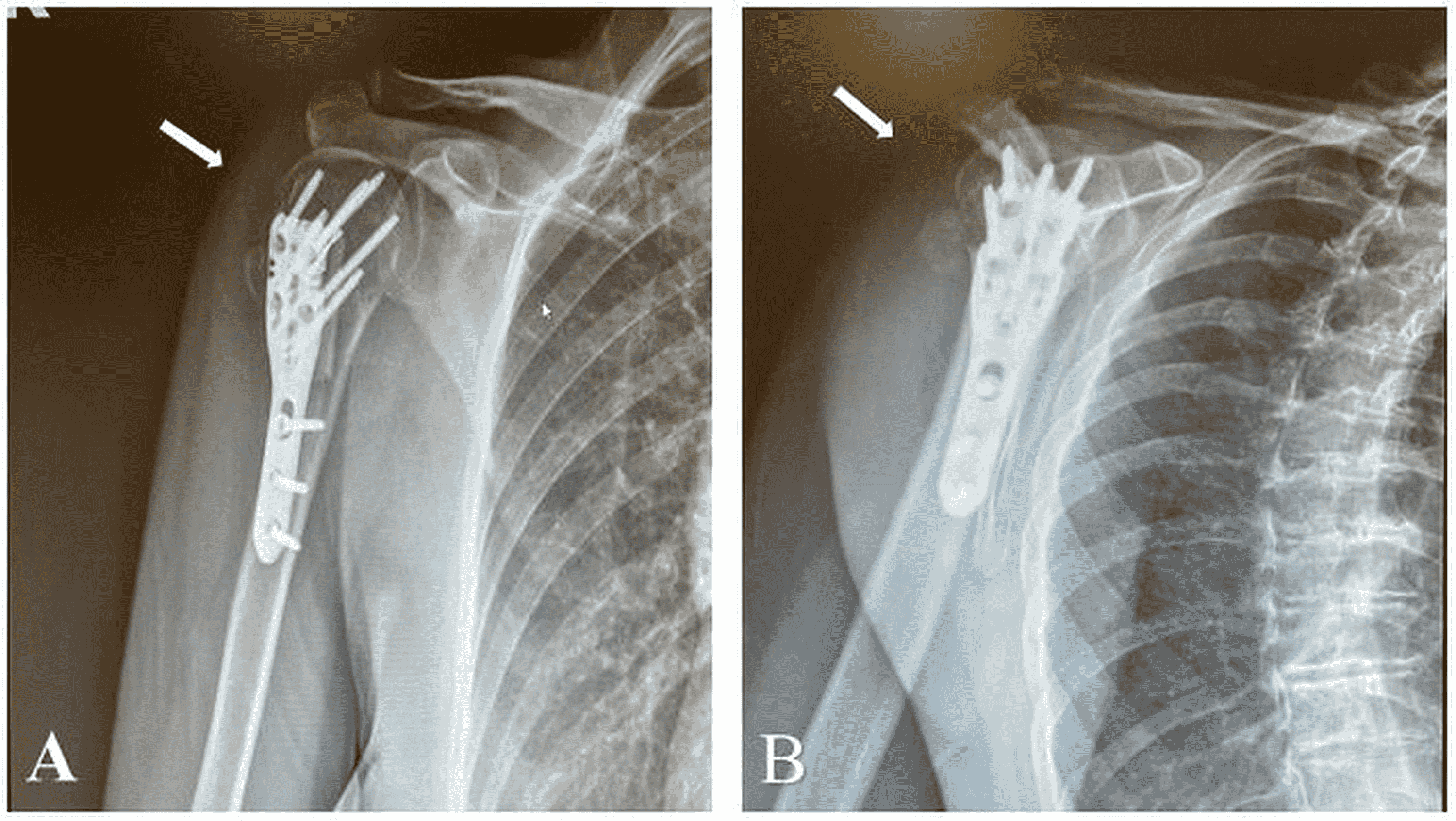 Shoulder And Elbow Surgery Proximal Humerus Fracture - vrogue.co