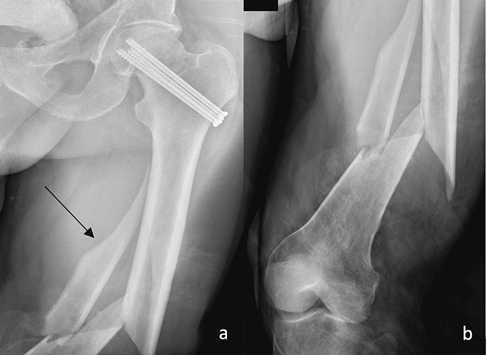 AAOS OVT - Lateral Decubitus Position for Intramedullary Femoral Nail