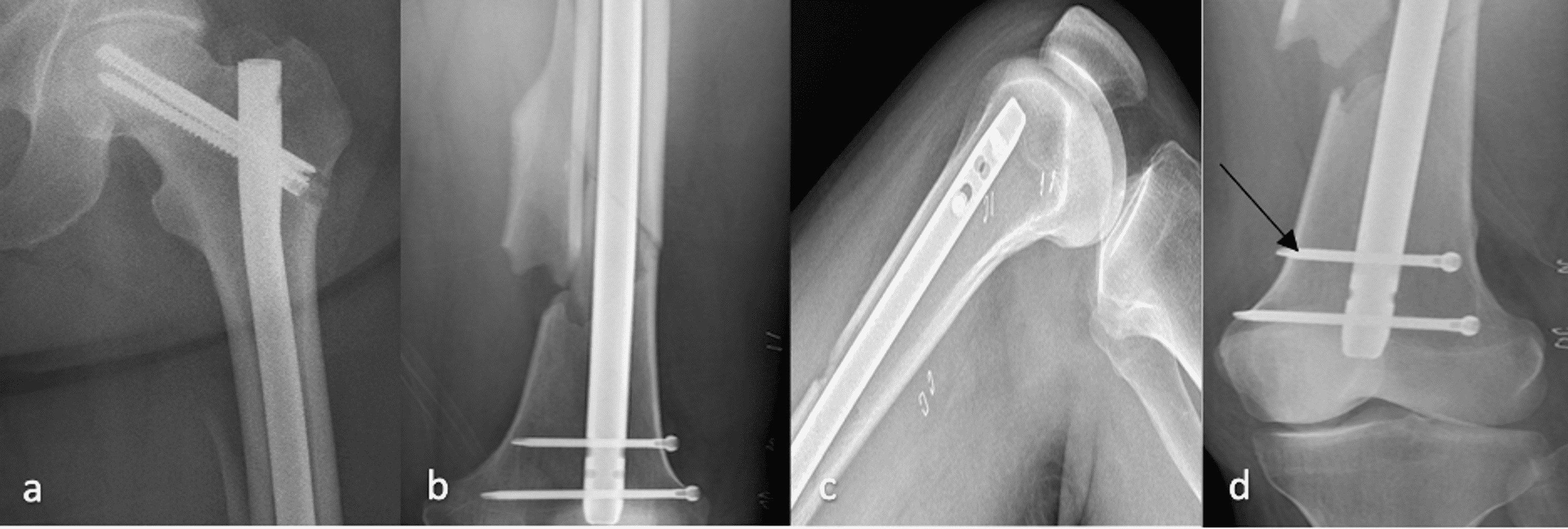 Cureus | Perforation of the Knee Joint Following Antegrade Intramedullary  Nailing of a Comminuted Femoral Diaphyseal Fracture: A Case Report | Article