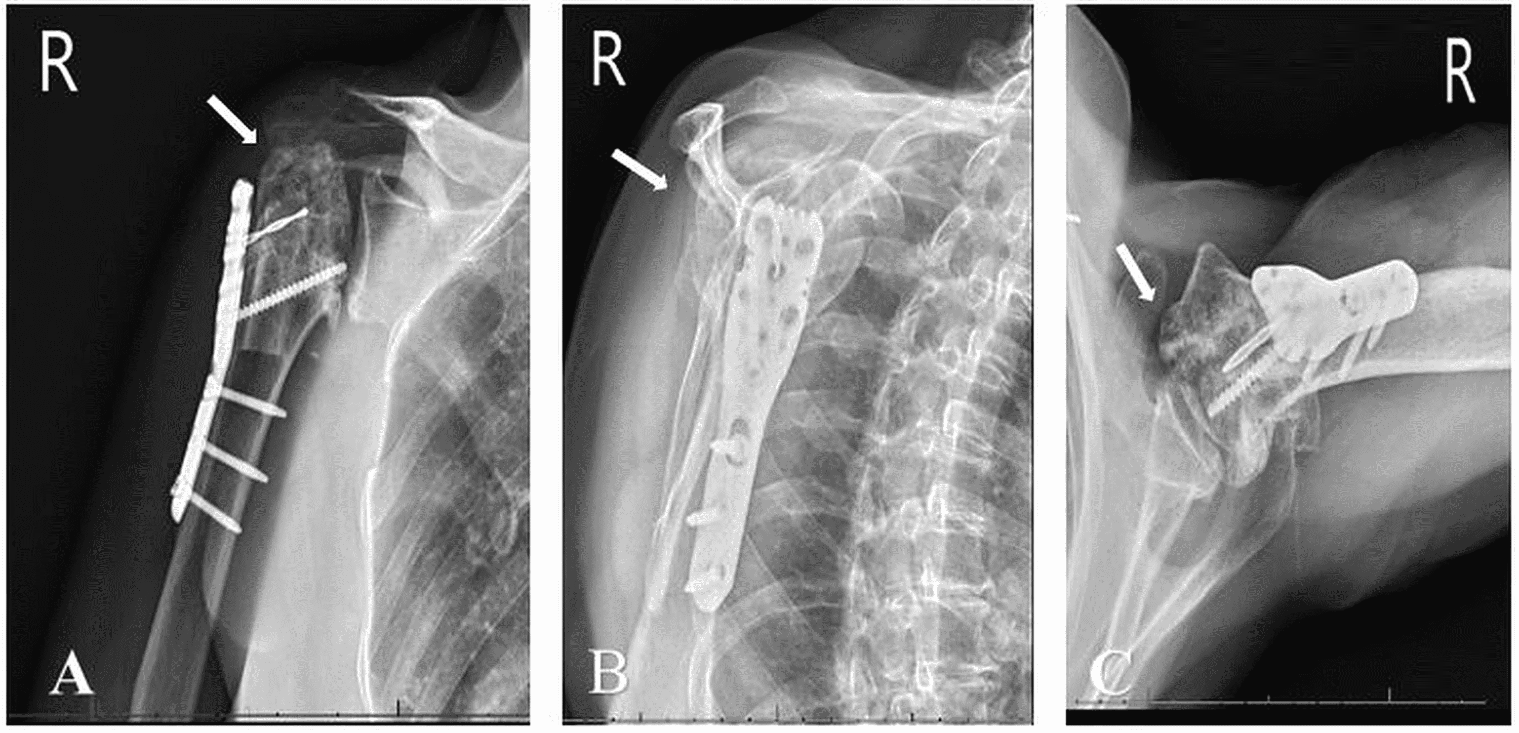 Cureus A Case of Proximal Humerus Fracture Dislocation Presenting