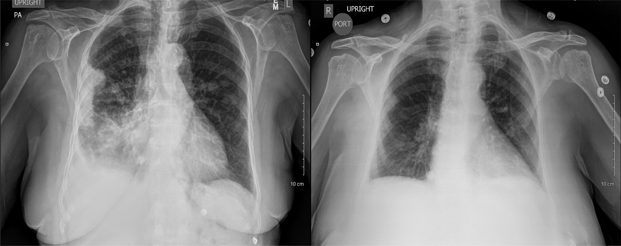 Cureus Malignant Pleural Mesothelioma Biphasic Type An Unusual And Insidious Case Of Rapidly Progressive Small Blue Cell Tumor