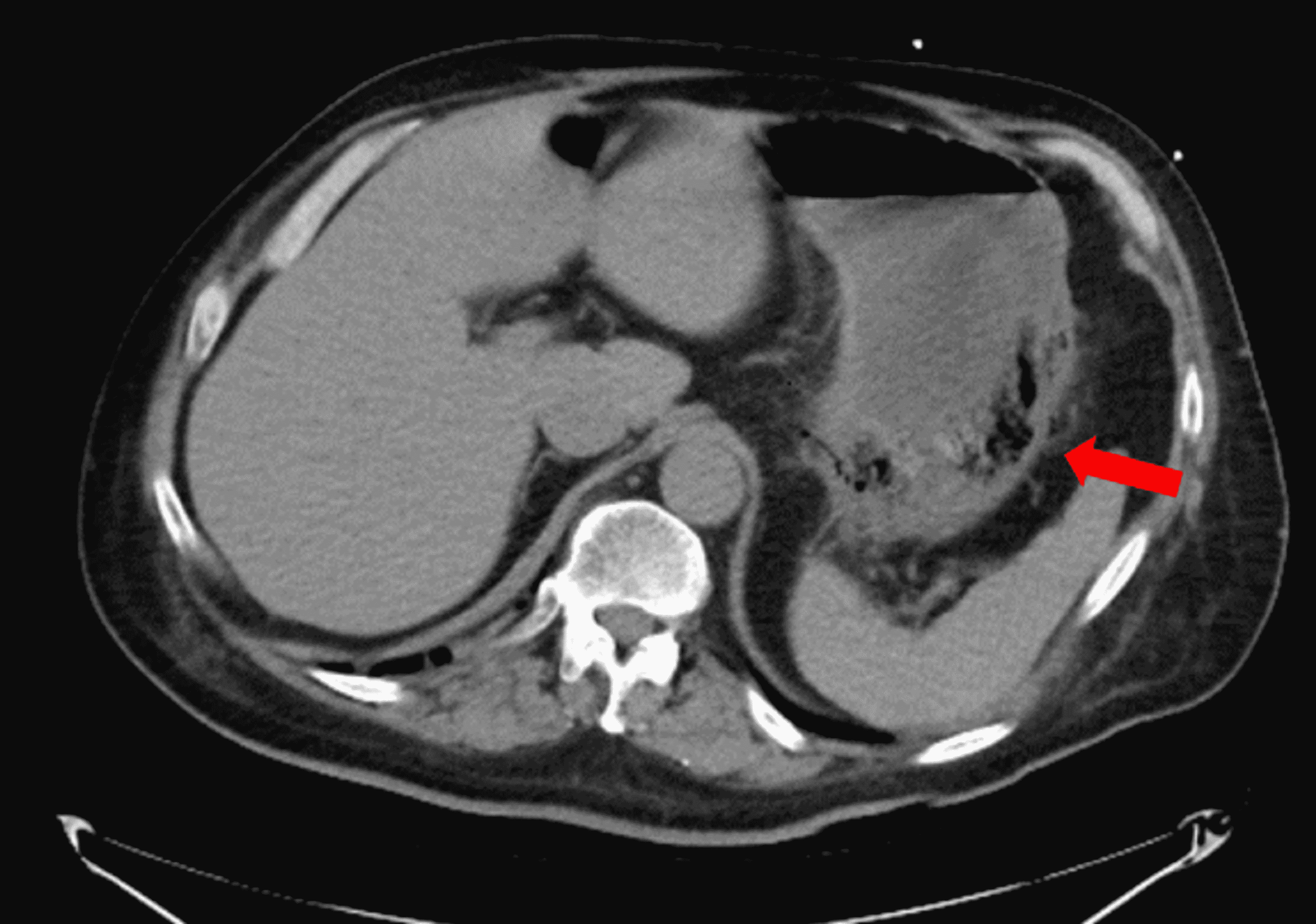 Cureus A Case Report of Successful Medical Management of