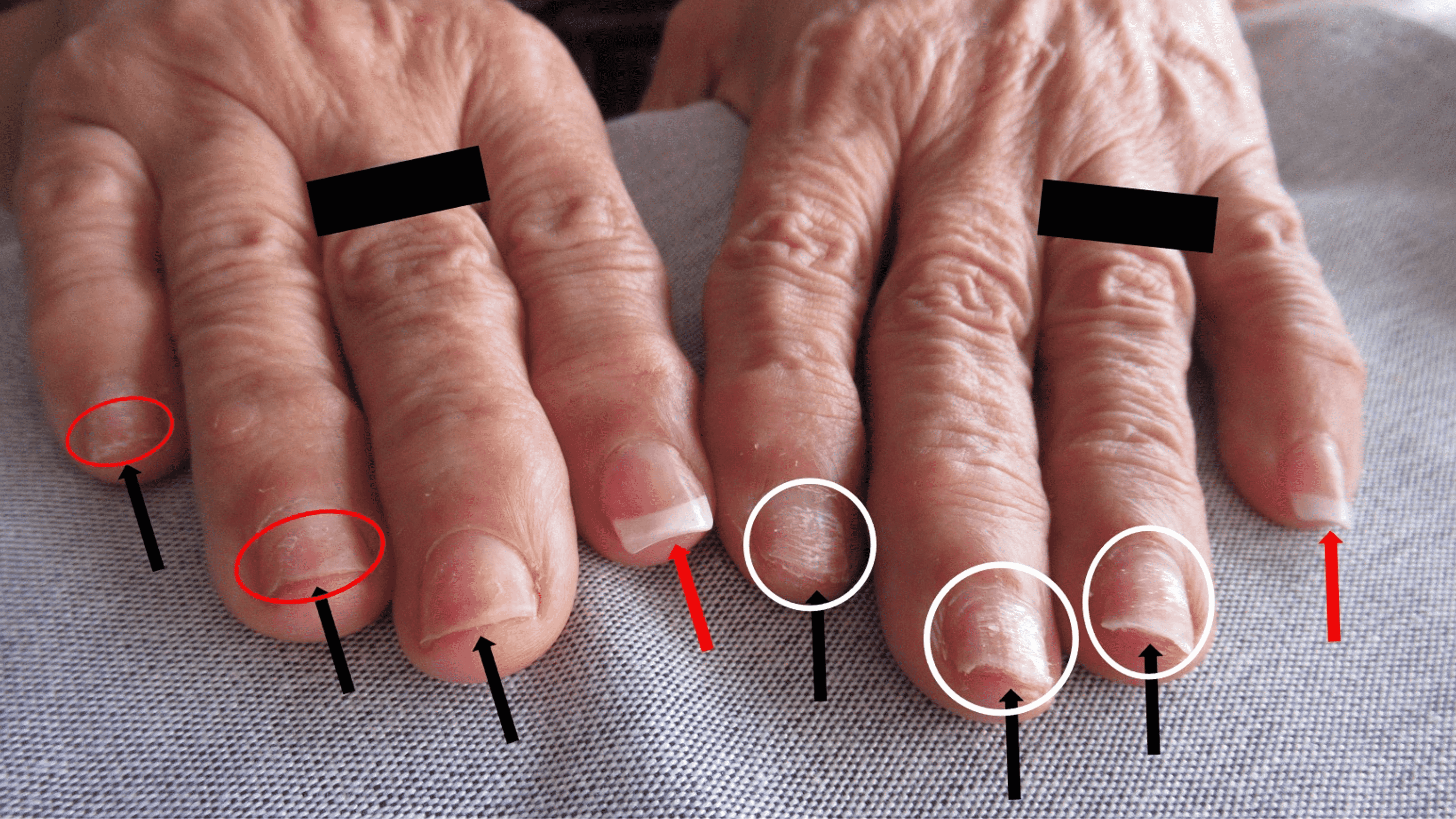Cureus | Nailing the Diagnosis: Onychotillomania in Patients With Artificial  Nails—An Underrecognized Phenomenon? | Article