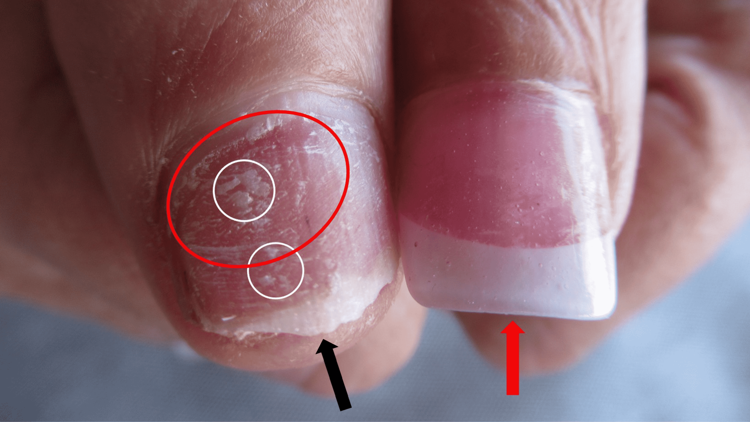 Cureus | Nailing the Diagnosis: Onychotillomania in Patients With  Artificial Nails—An Underrecognized Phenomenon? | Article