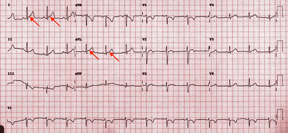 EKG-showing-normal-sinus-rhythm-with-ST-segment-elevation-in-some-lateral-leads-(I-and-aVL)