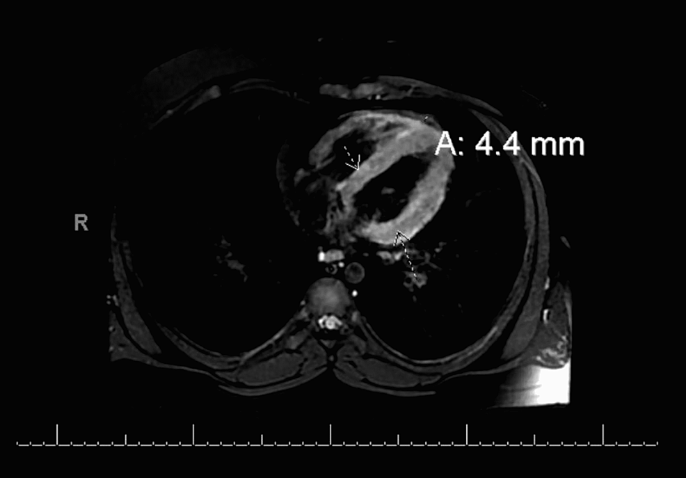 Cardiac-MRI