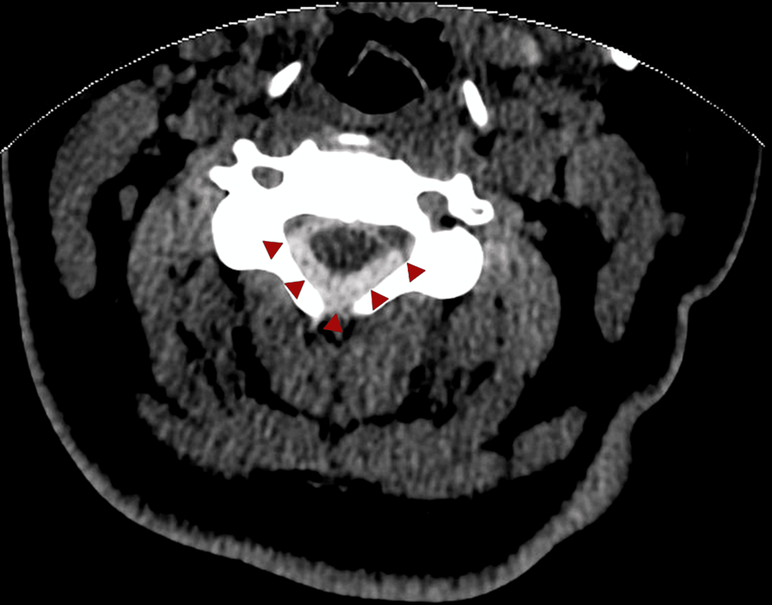 Cureus Ventral Spinal Cord Herniation Causing Spinal Intradural