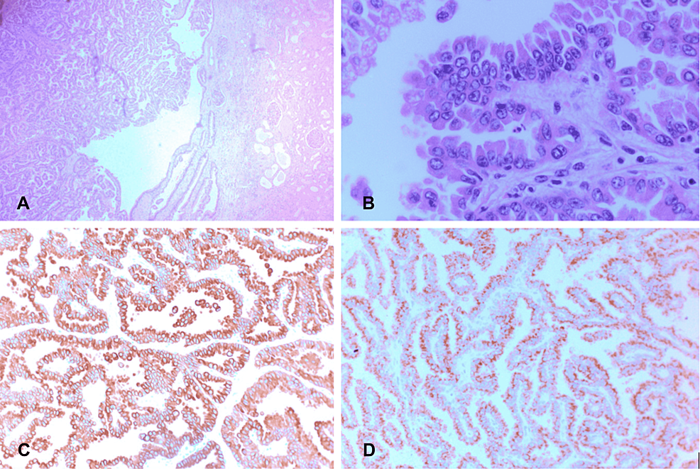 metastatic-type-ii-papillary-renal-cell-carcinoma-with-recurrent