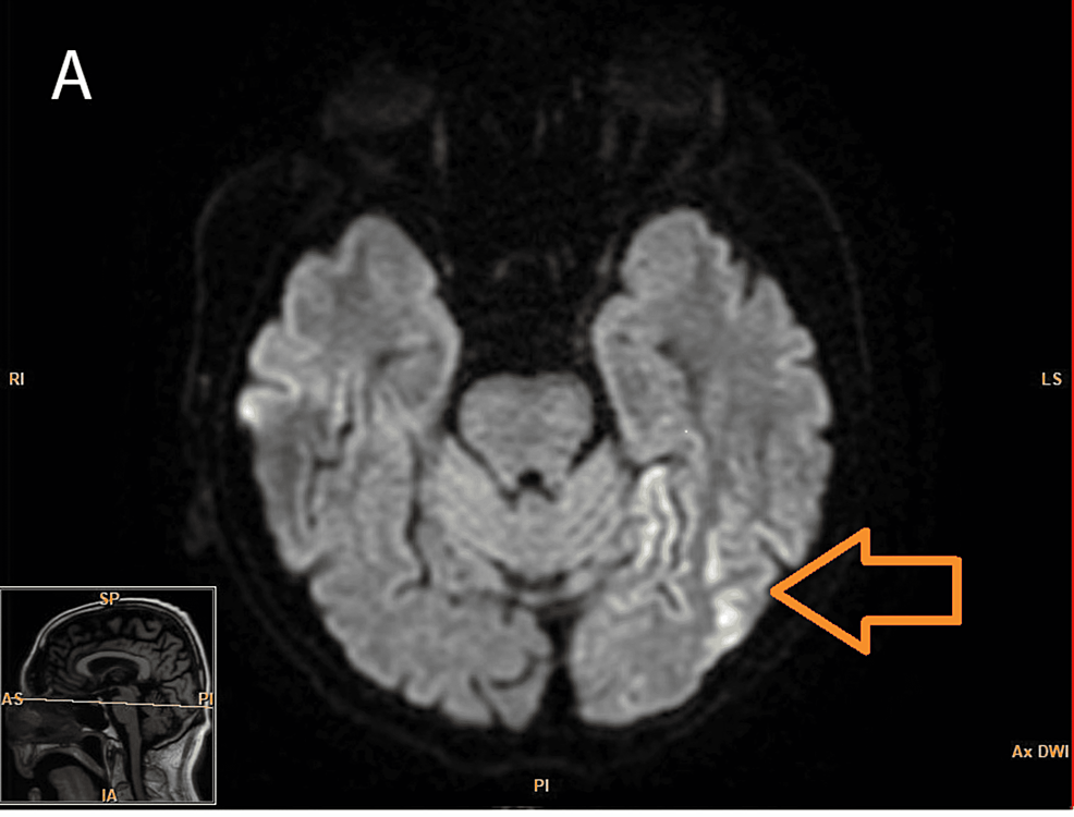 Axial-diffusion-weighted-MRI-showing-hyperintensities