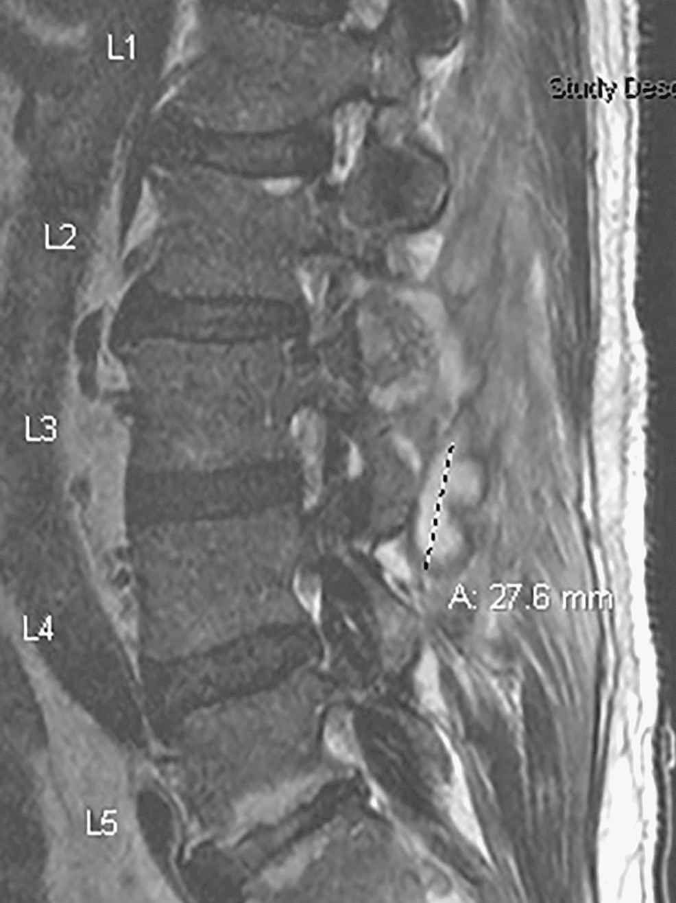 MRI-(SAG-T2-sequence)-showing-peripherally-enhancing-abscess-spanning-the-approximate-upper/mid-L3-vertebral-body-level-to-the-superior-L4-vertebral-body-level,-located-within-the-left-posterior-epidural-space-of-the-spinal-canal