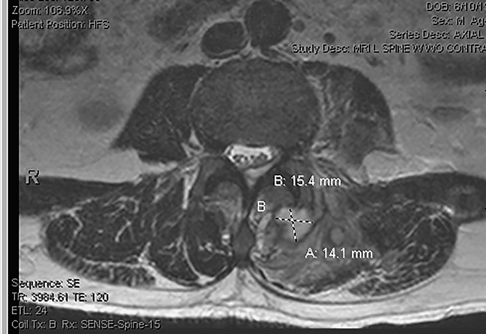 MRI-(axial-T2-sequence)-showing-multifocal-left-paraspinal-abscesses-and-phlegmon,-with-some-possible-communication: T2-hyperintense-left-paraspinal-collection-at-the-approximate-L4-level-measures-roughly-1.4-cm-(AP)-x-1.5-cm-(TRV)-x-2.8-cm-(SI)-and-abuts-the-dorsal-aspect-of-the-left-L3-L4-facet-joint.