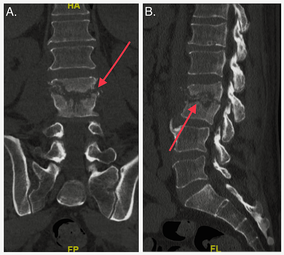 Cureus | A Rare Case Of Candida Parapsilosis Lumbar Discitis With ...