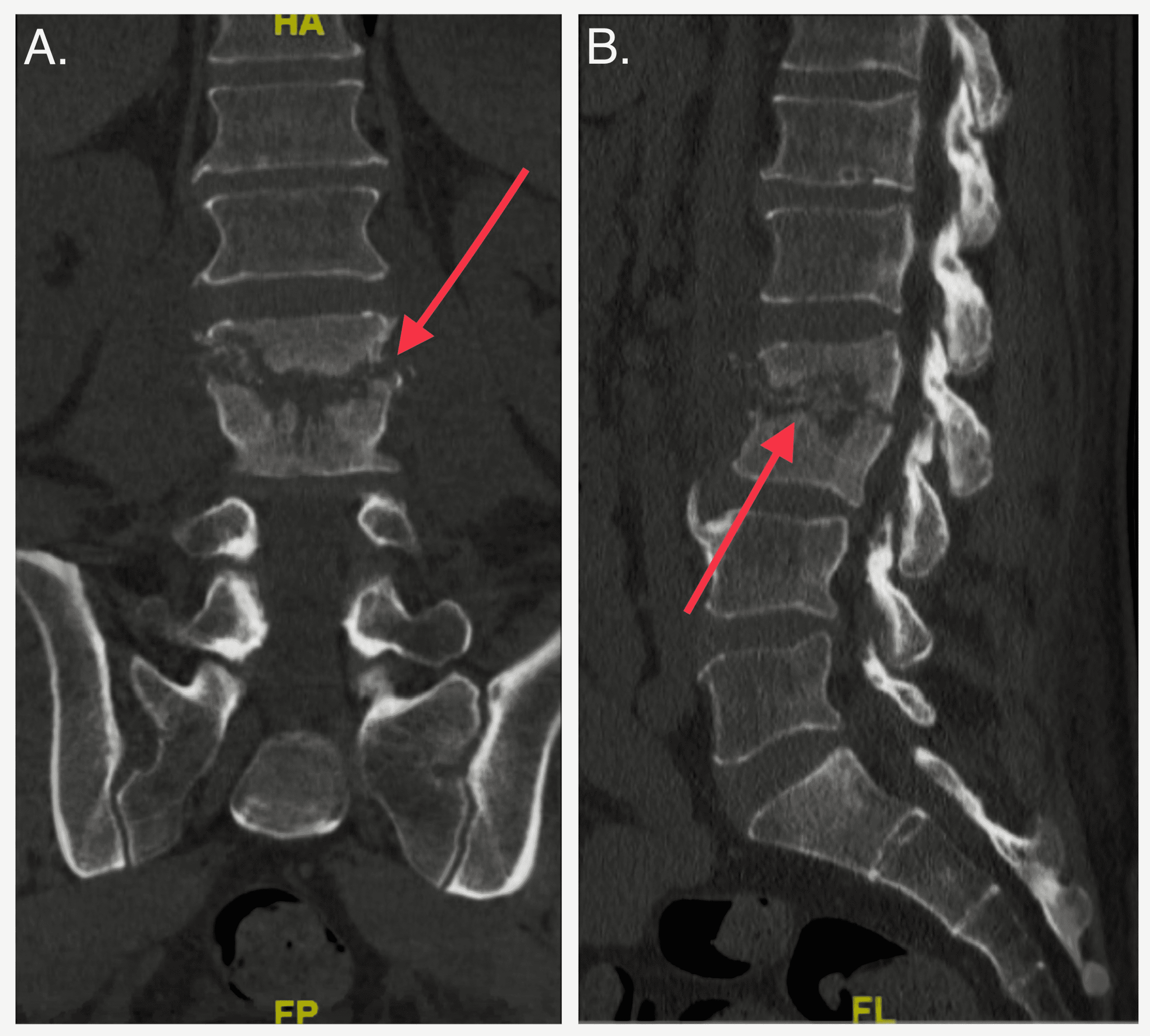 Cureus A Rare Case of Candida parapsilosis Lumbar Discitis With Osteomyelitis