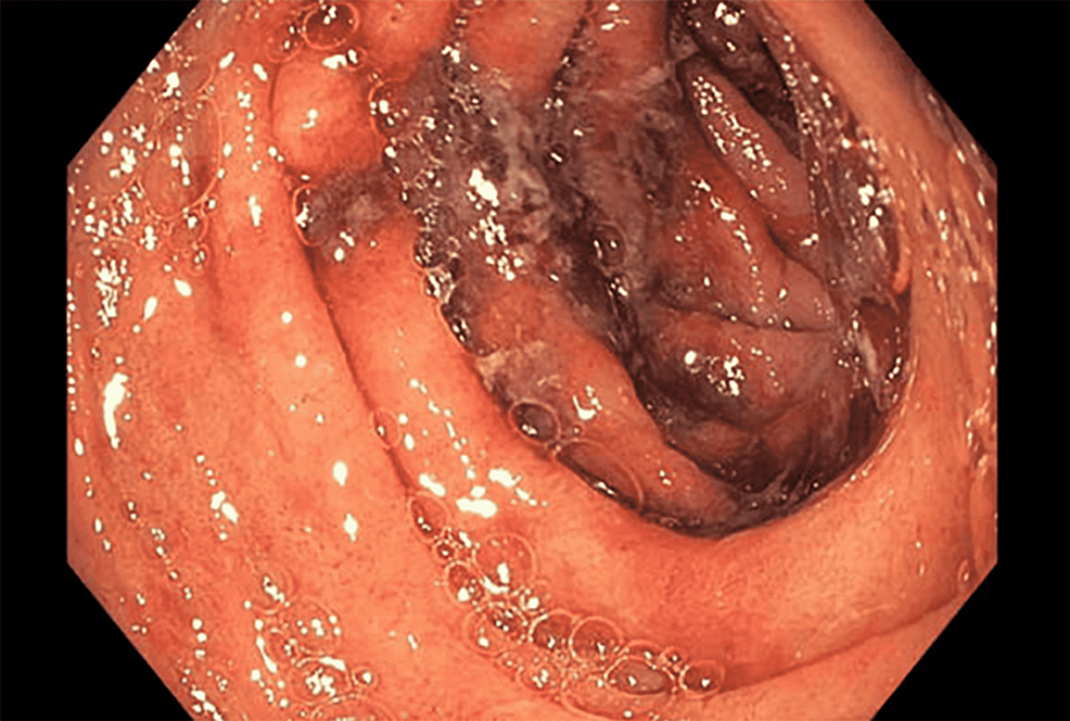 Upper-endoscopy-(EGD)-of-the-second-portion-of-duodenum-with-segmental-severe-inflammation-with-hemorrhage-characterized-by-adherent-blood,-congestion,-edema,-erosions,-erythema,-friability,-and-deep-ulcerations.