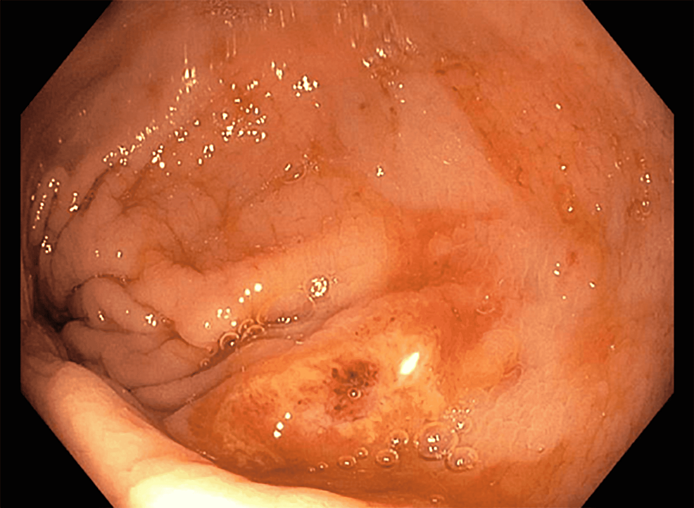 Colonoscopy-demonstrating-patchy-moderate-inflammation-characterized-by-congestion,-edema,-erosions,-and-erythema-found-in-the-rectum.