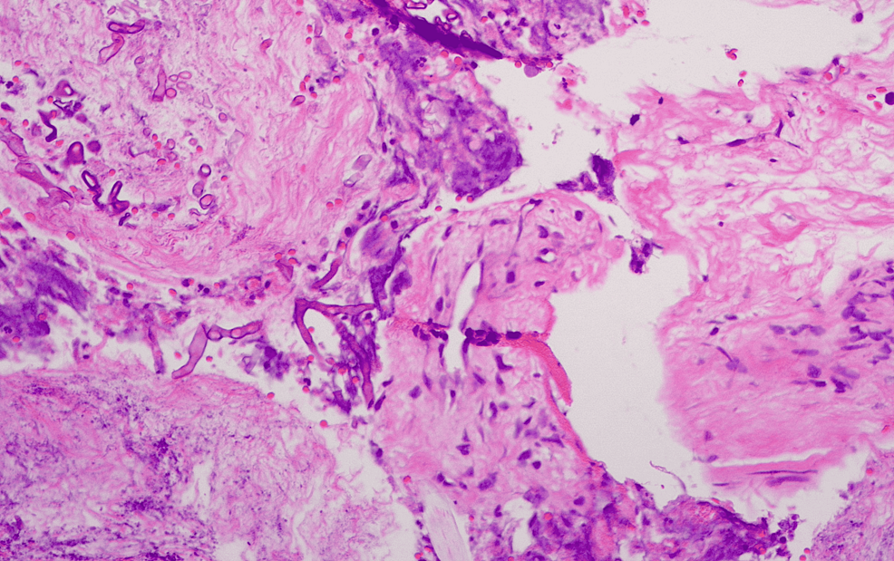 Histopathology-results:-Necrotic-tissue-and-mycelia.