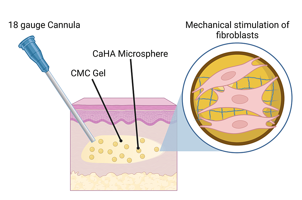Proposed-biostimulatory-mechanism-of-action-of-CaHA-injected-subdermally-via-18-gauge-cannula