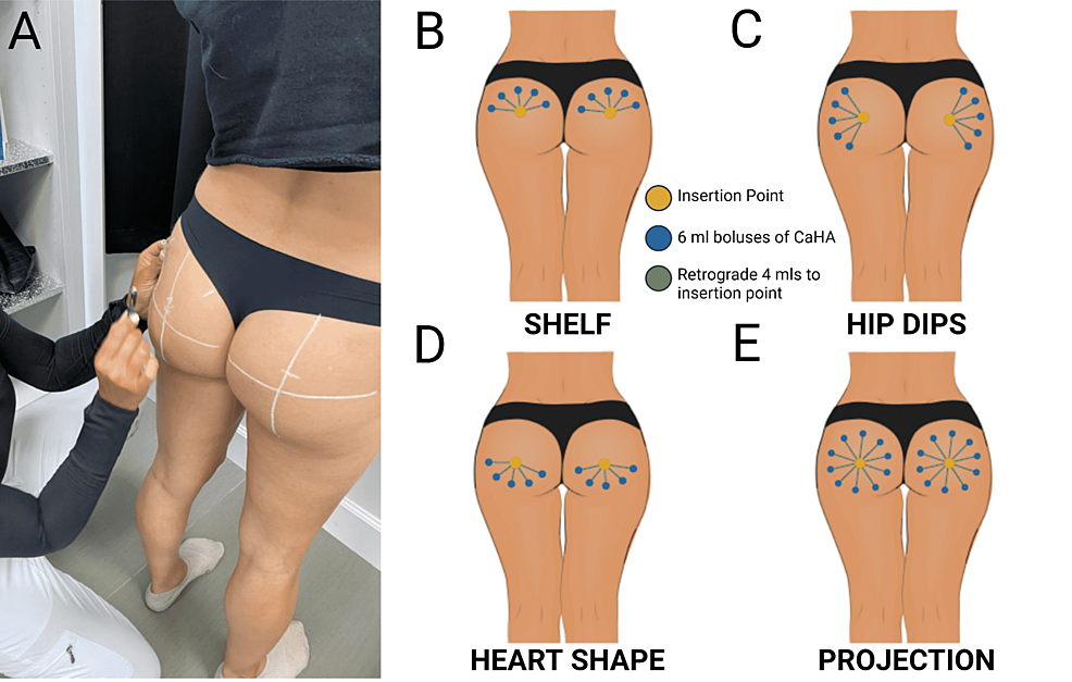 Injection-marking-and-techniques-for-shape-distinct-augmentation