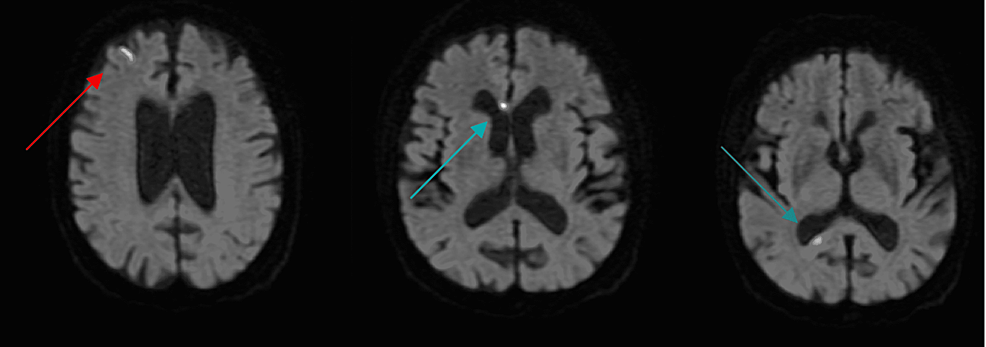 Predictors of Device-Related Thrombus Following Percutaneous Left