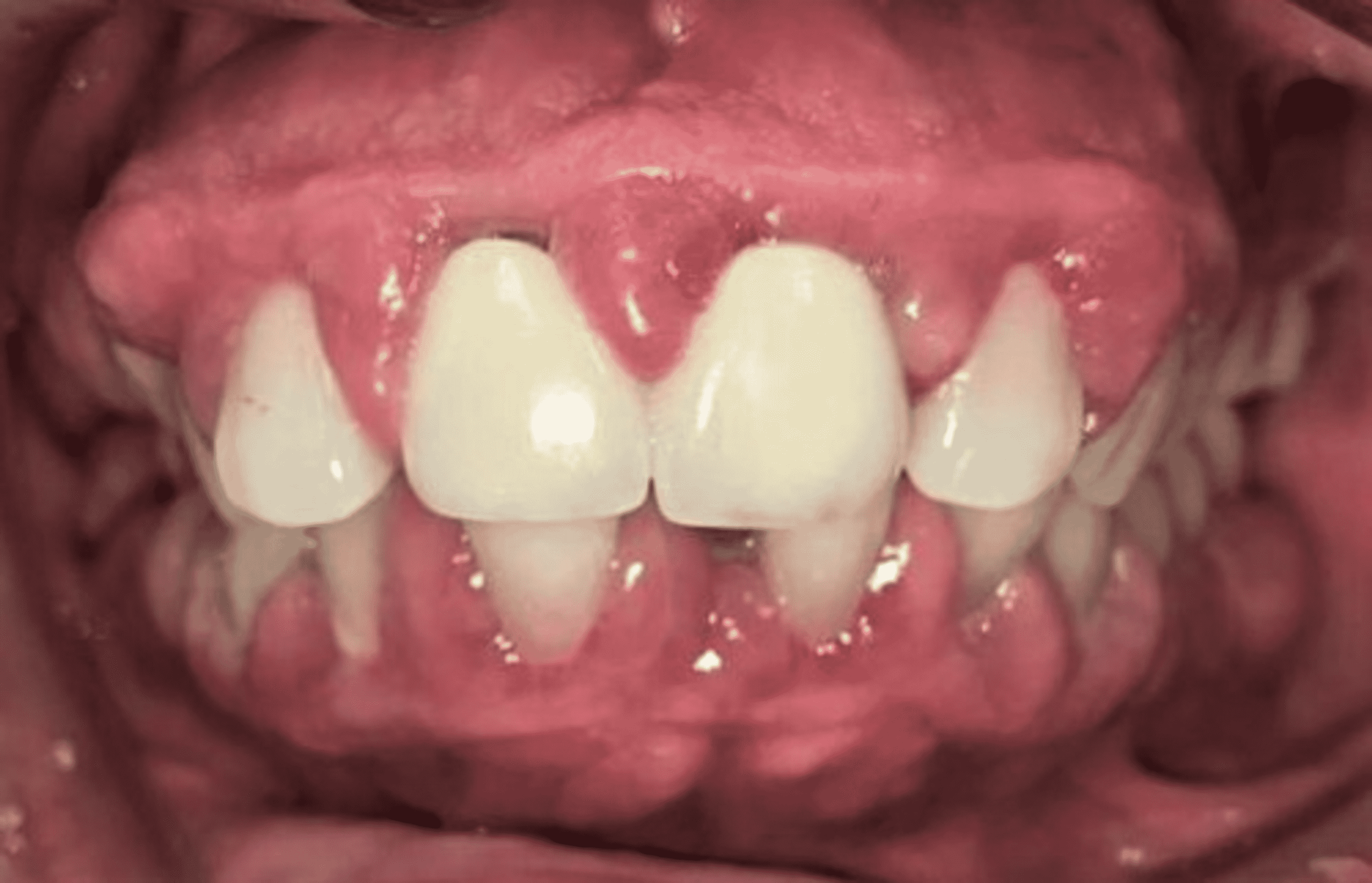 Cureus Refining The Mechanism Of Drug Influenced Gingival Enlargement