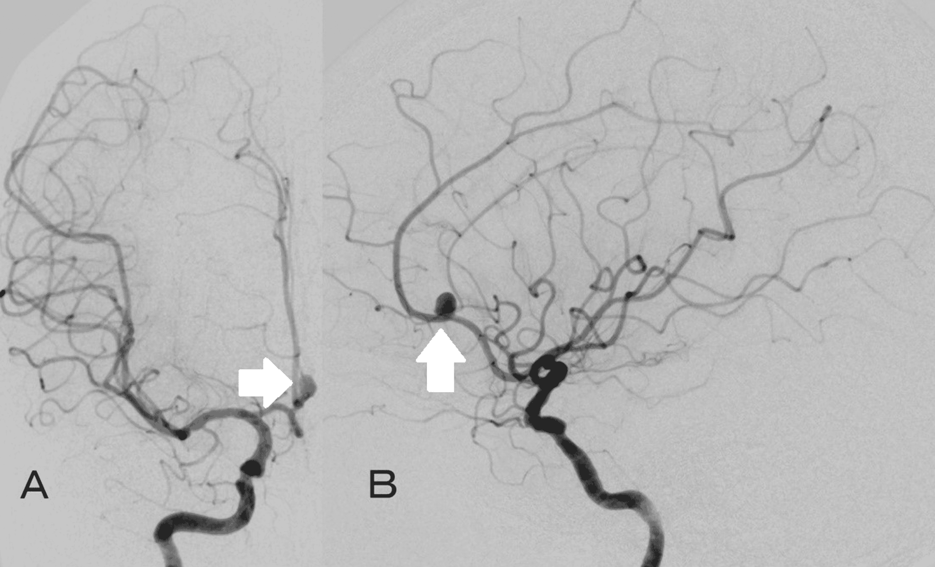 Cureus Coil Embolization of Unruptured Distal Anterior Cerebral