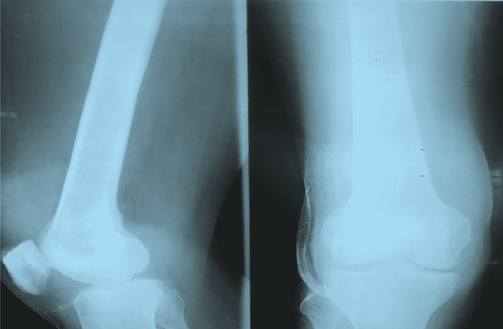 X-ray-of-the-right-knee-joint-showing-soft-tissue-swelling