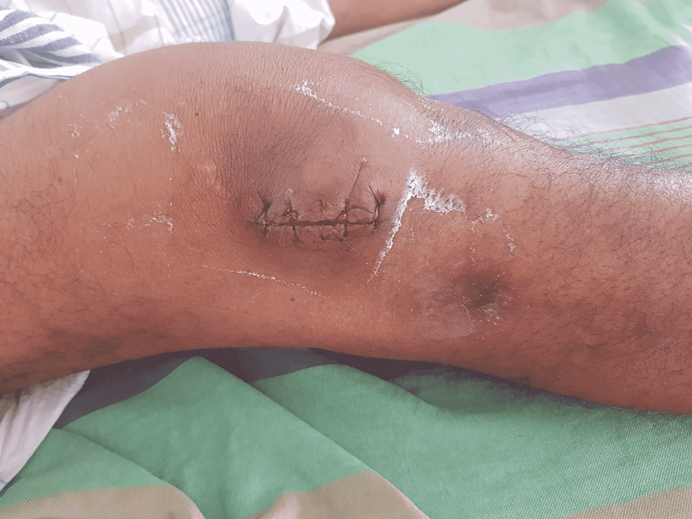 Right-knee-joint-sutured-following-arthrotomy-and-drainage-tube-kept-in-situ-for-72-hours