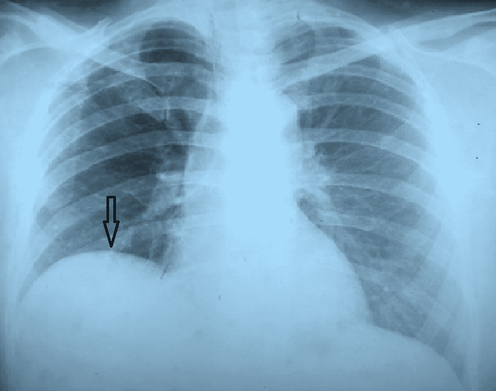 Chest-X-ray-showing-right-diaphragmatic-elevation-due-to-liver-abscess