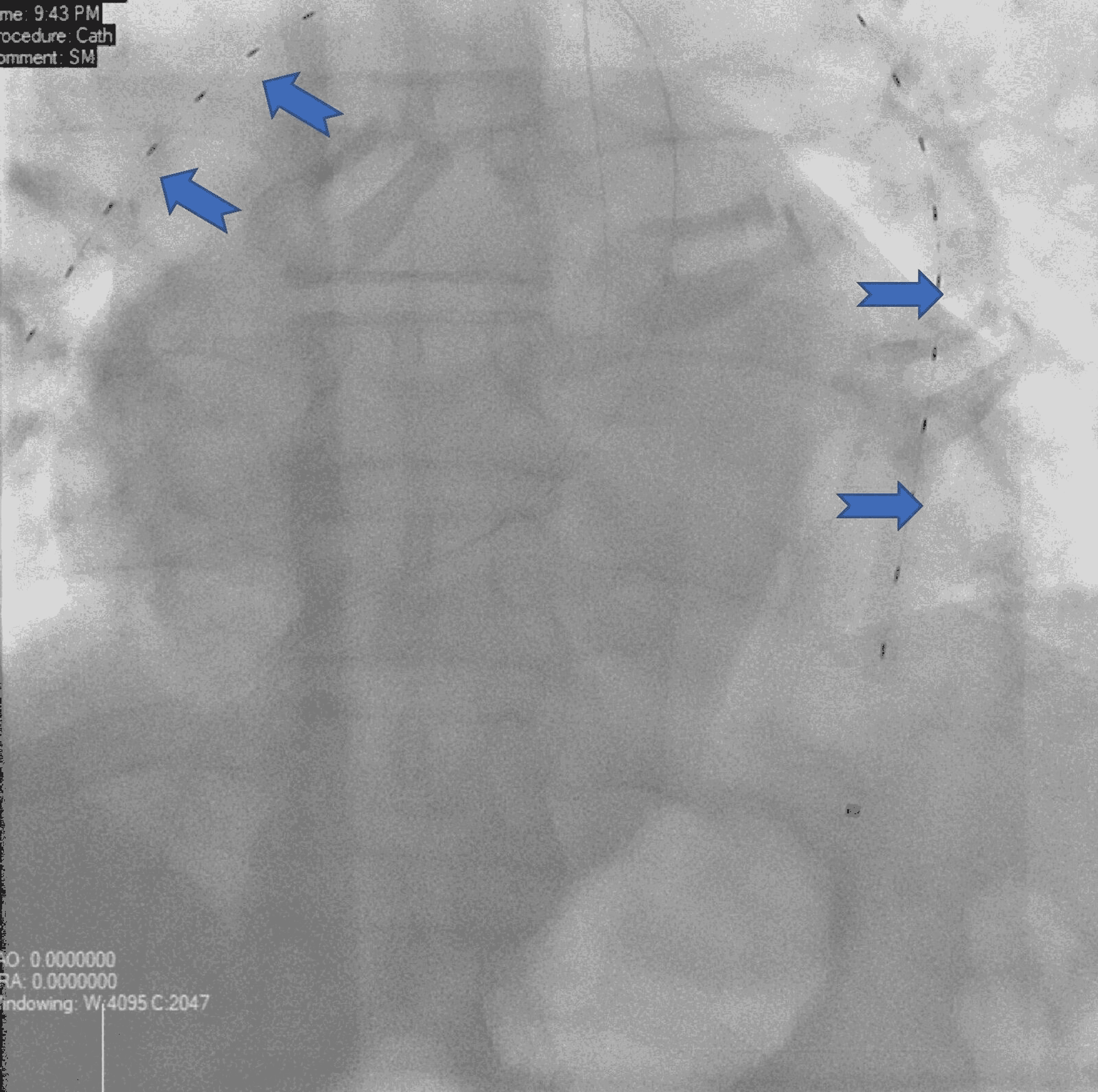 Cureus A Case Report of Large Bilateral Pulmonary Embolism in a
