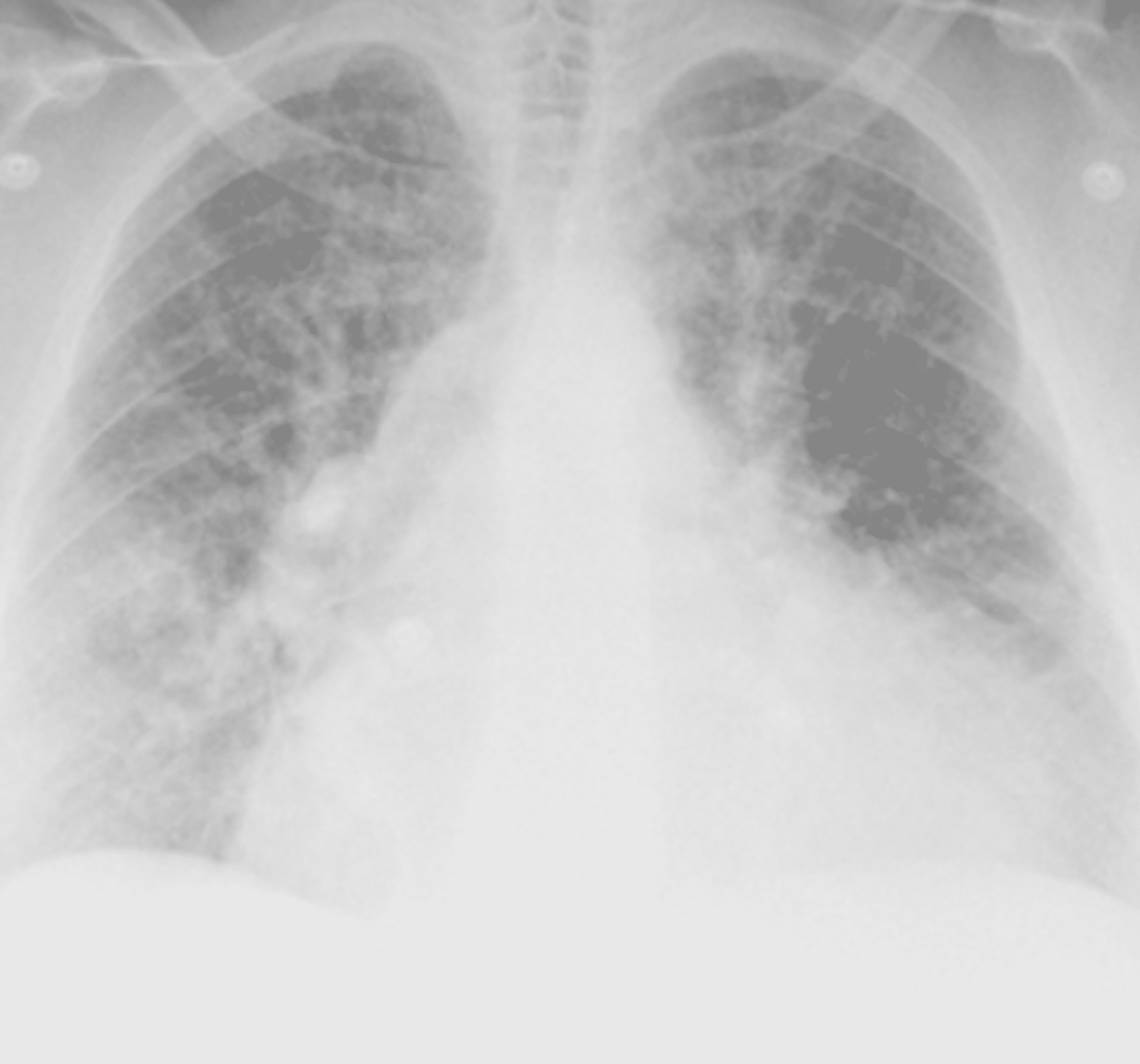 Cureus | A Case of Foix-Chavany-Marie Syndrome With Asynchronous ...