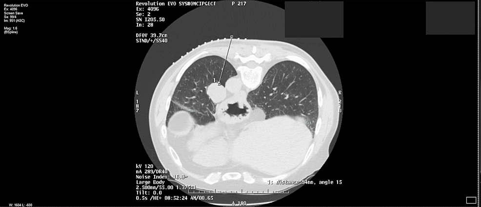 Computed-tomography-scan-showing-pulmonary-carcinoid-tumor-prior-to-surgical-resection