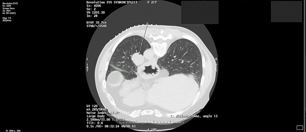 The Importance of Coughing After Surgery