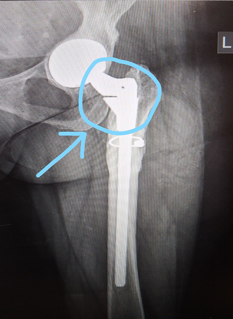 Post-operative-X-ray-with-the-'happy-elephant-sign'