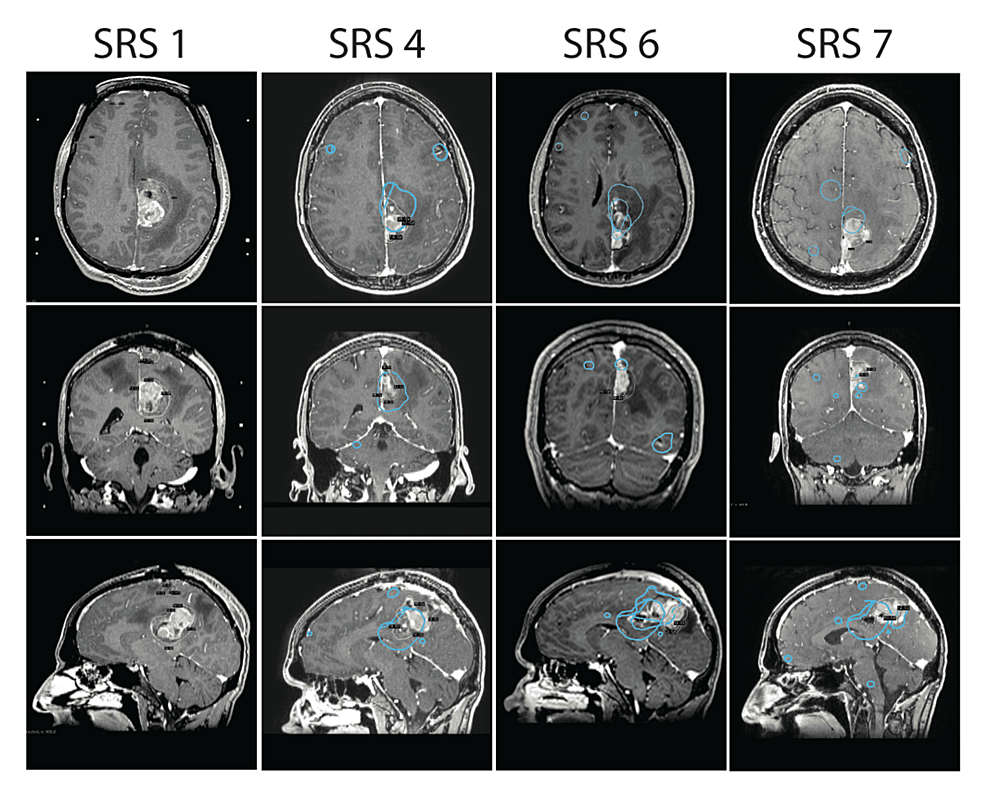 Local-tumor-recurrence-in-the-motor-cortex-in-axial,-coronal-and-sagittal-views-with-stereotactic-dosage-and-location.