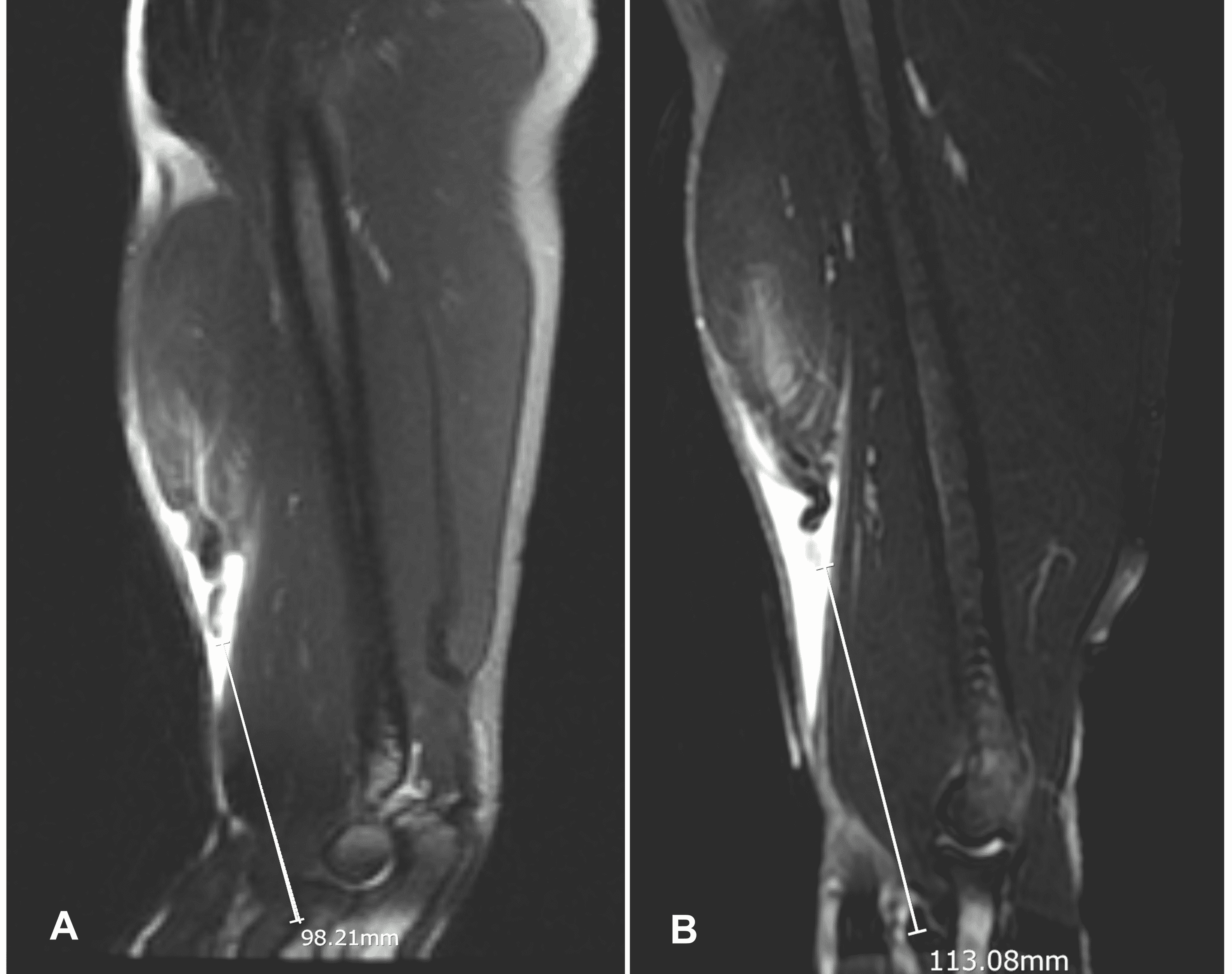 Cureus Staged Achilles Allograft Reconstruction Of Chronic Bilateral Simultaneous Tears Of The