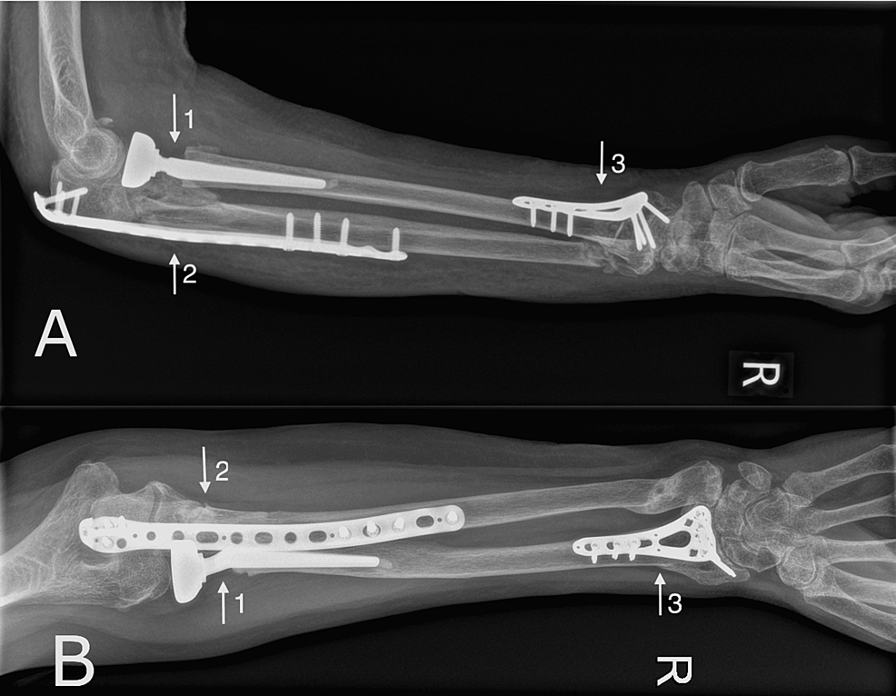 Floating Forearm Injury: Monteggia Variant Fracture With An Ipsilateral ...