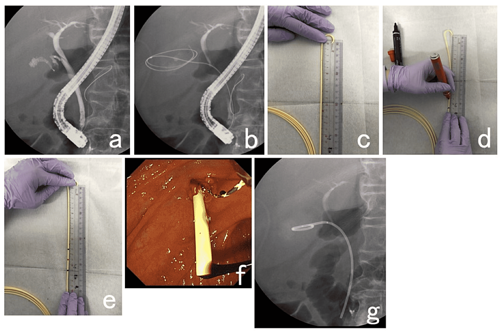 Feasibility Of A Single Pigtail Stent Made By Cutting A Nasobiliary ...