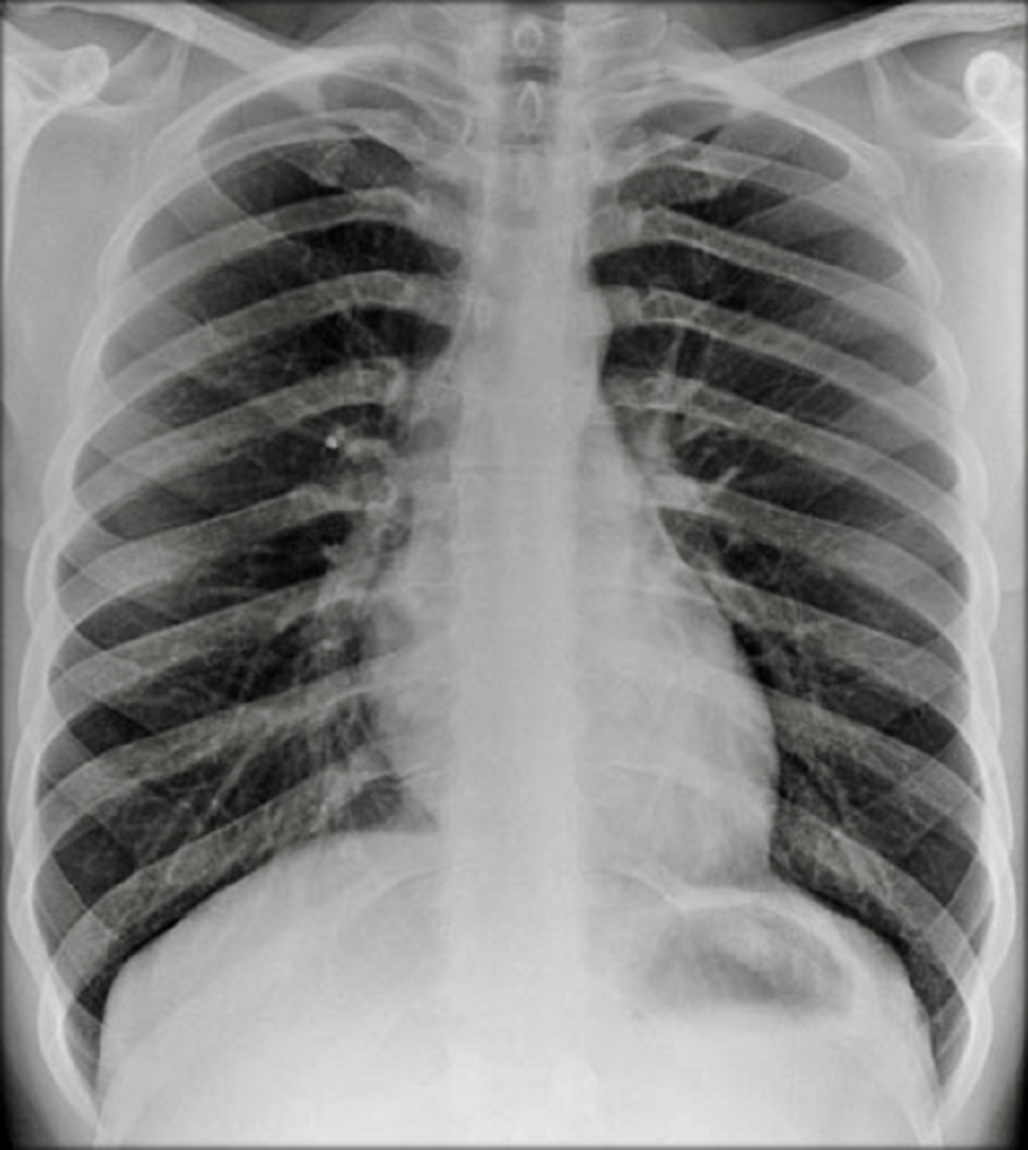 Cureus Pulmonary Involvement in Crohn’s Disease A Rare Case Report