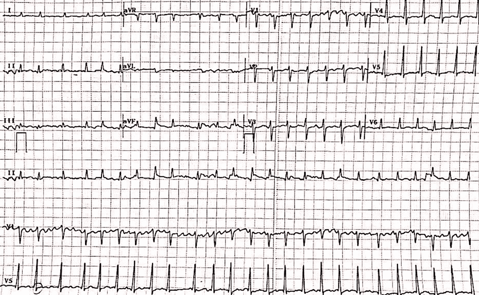 Cureus | Atrial Fibrillation in Scrub Typhus: A Series of Four Cases