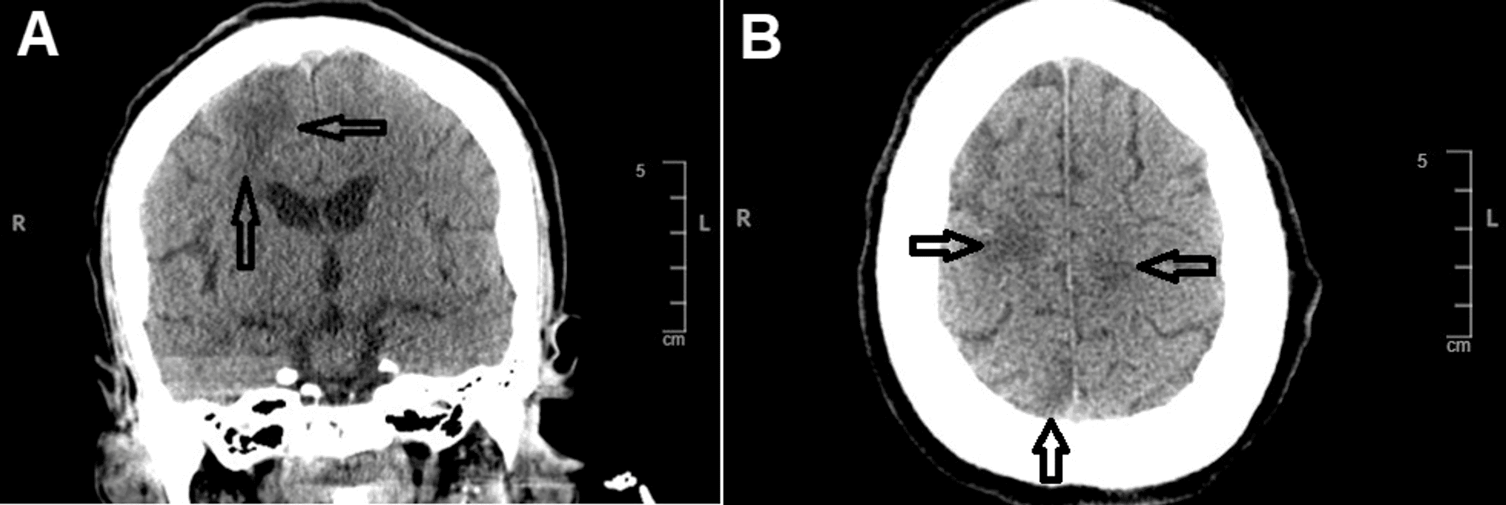 Cureus Lupus Cerebritis as a Rare Neuropsychiatric Manifestation of