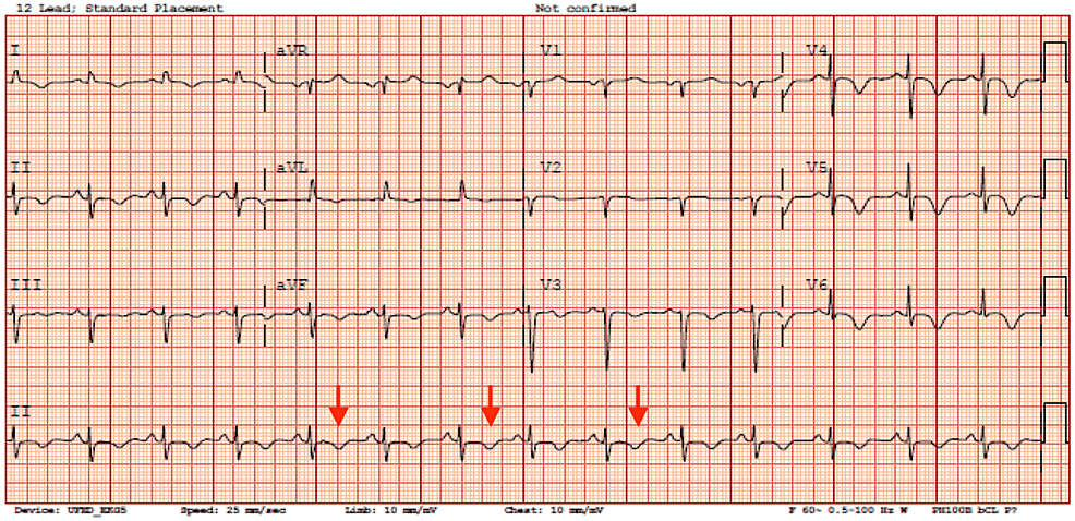 Cureus | Spontaneous Coronary Artery Dissection-Induced Takotsubo Syndrome