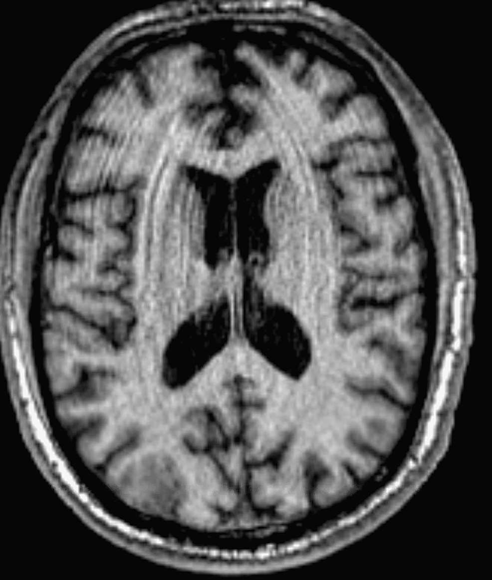 Cureus Asymptomatic Cryptogenic Brain Abscess A Case Report