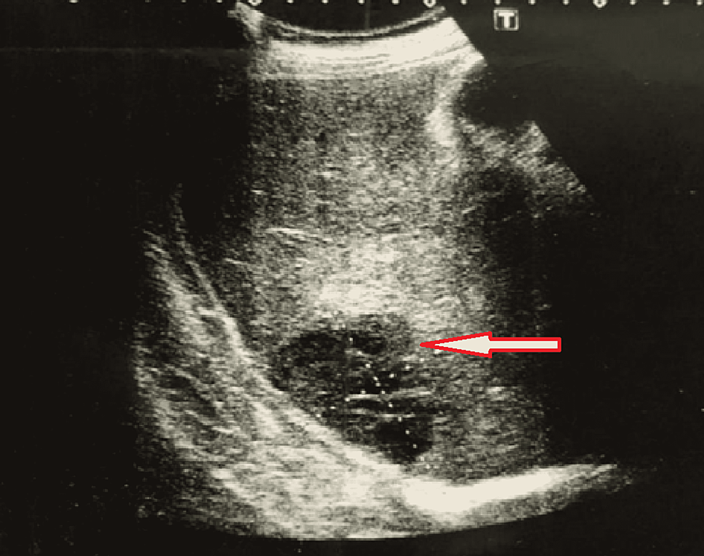 Ultrasound-of-the-abdomen-revealing-hepatic-abscess