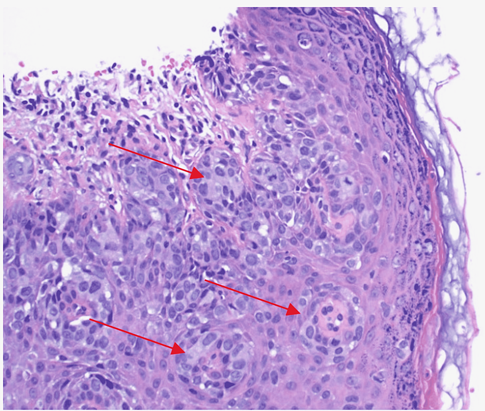 Cureus Scrotal Extramammary Paget’s Disease in an Elderly Caucasian Male