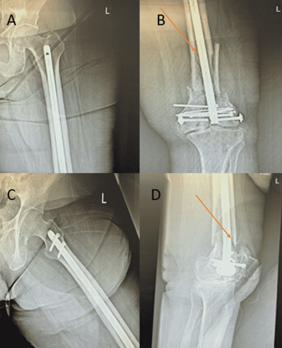 Cureus Retrograde Intramedullary Nailing Hardware Failure of a